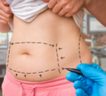 ניתוח מתיחת בטן: מה חדש?